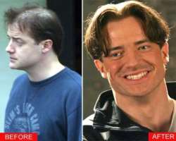 Brendan Fraser before surgery